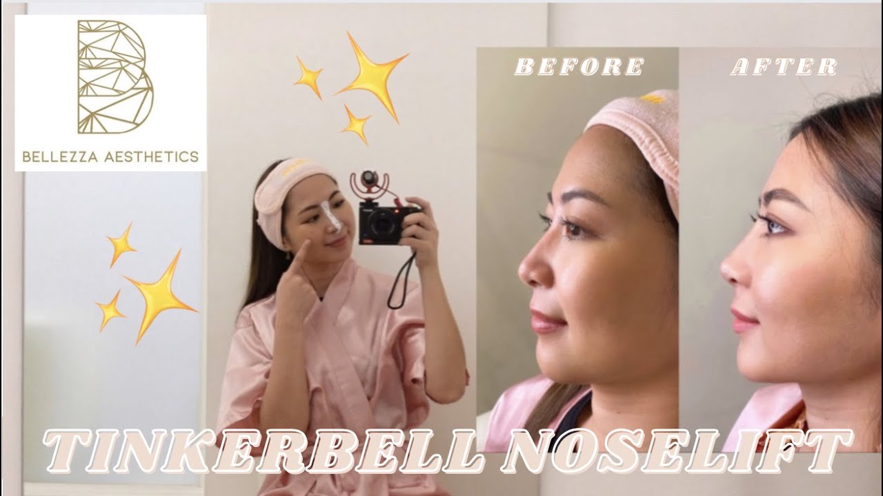 Процедура Tinkerbell Noselfit | Bellezza Aesthetics | Безоперационная подтяжка носа | Филлеры для...