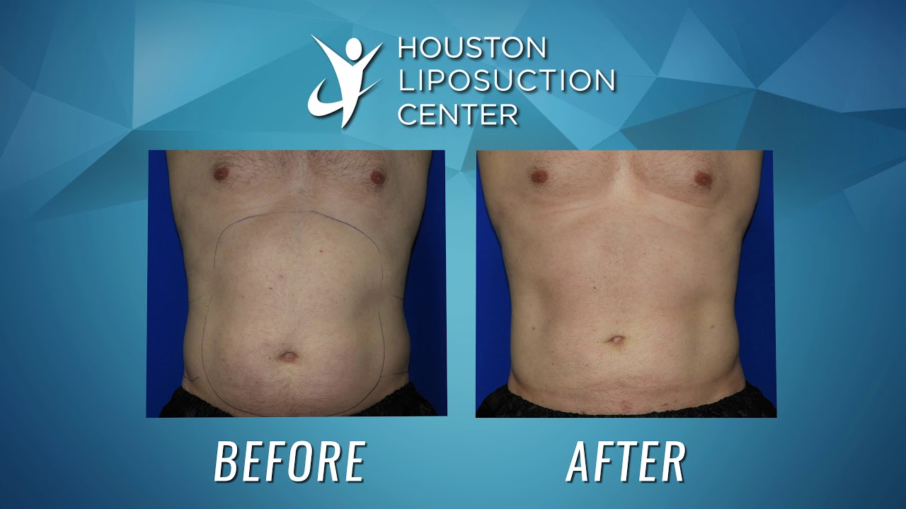 Liposuction for Men ~ Liposuction Before & After ~ Abdomen Liposuction