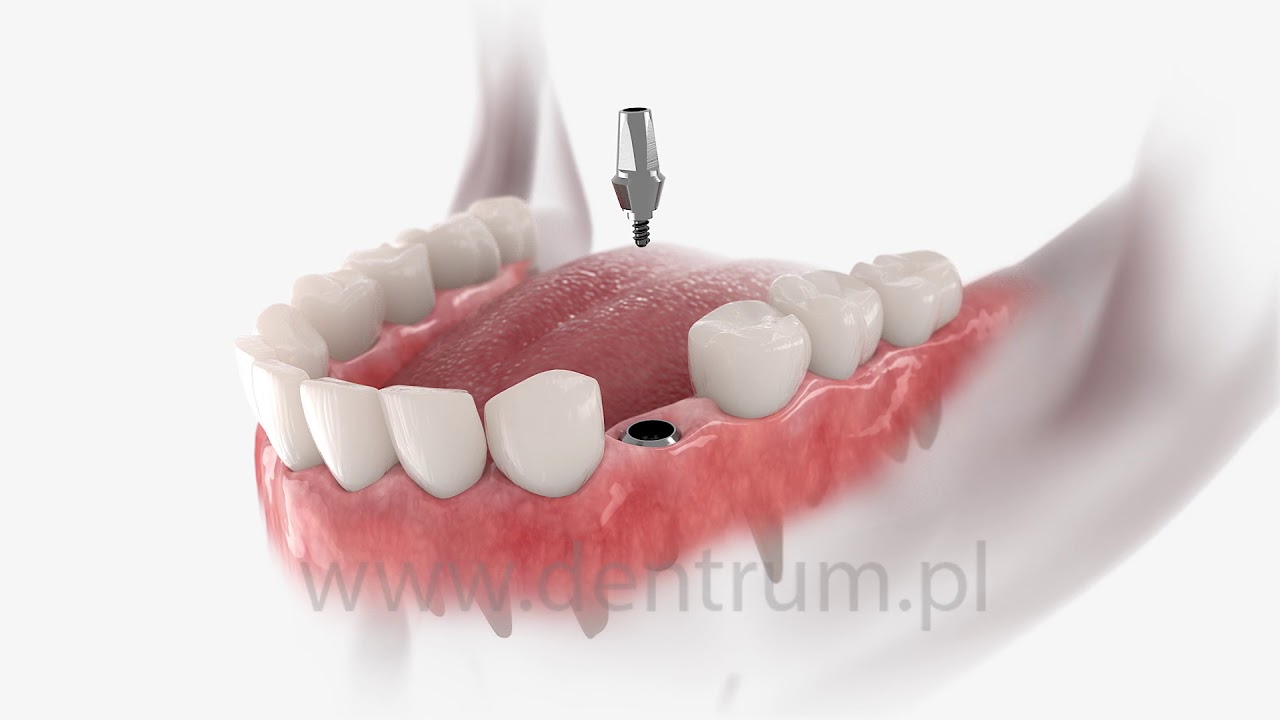 Implant zęba