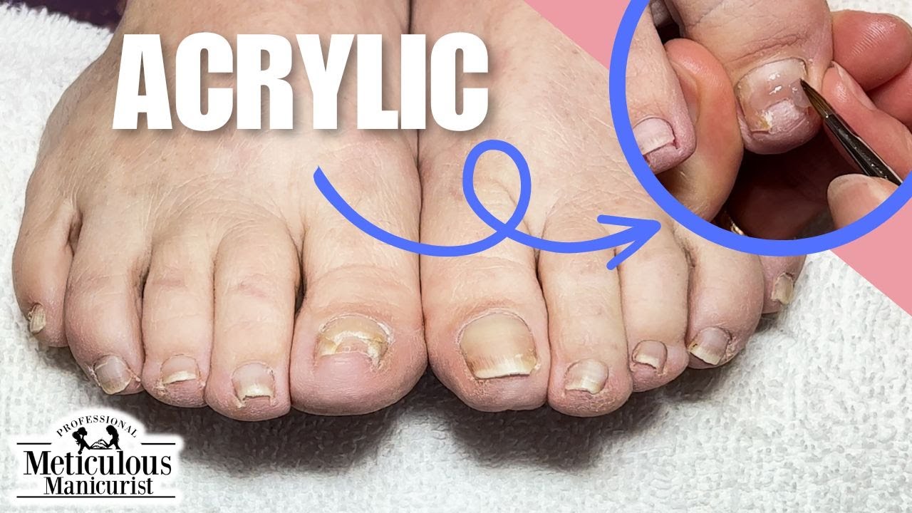 Big Toenail Repair Pedicure Tutorial at Home