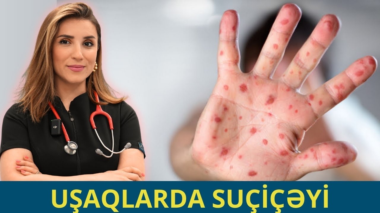 SUÇİÇƏYİ xəstəliyi zamanı DƏRİYƏ QULLUQ - NƏLƏRİ ETMƏK OLMAZ?! | Pediatr Aytən Ziyadova