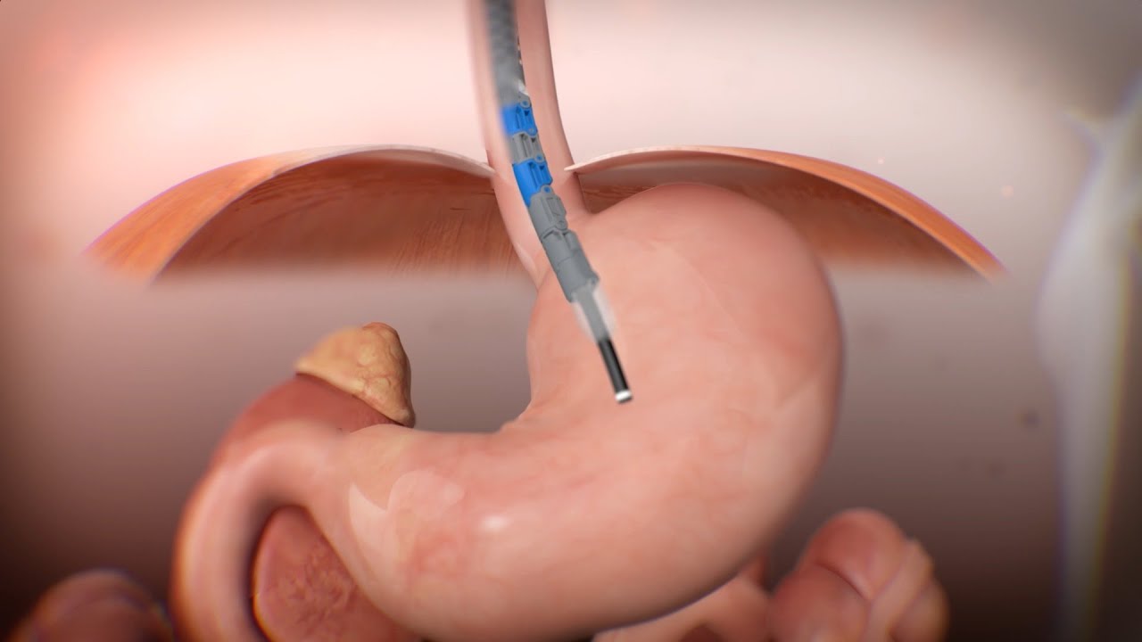 Dr. Jamil - TIF procedure for GERD