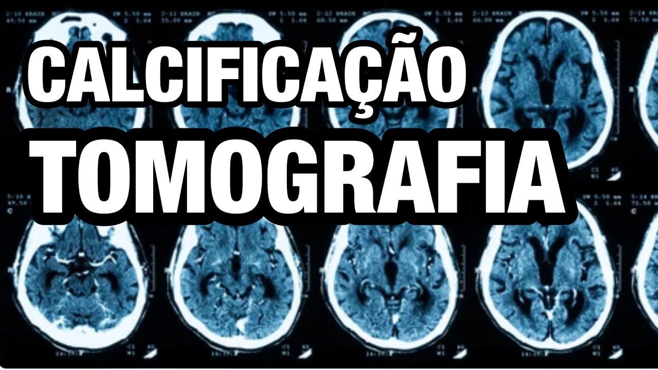 O que pode ser uma calcificação cerebral?