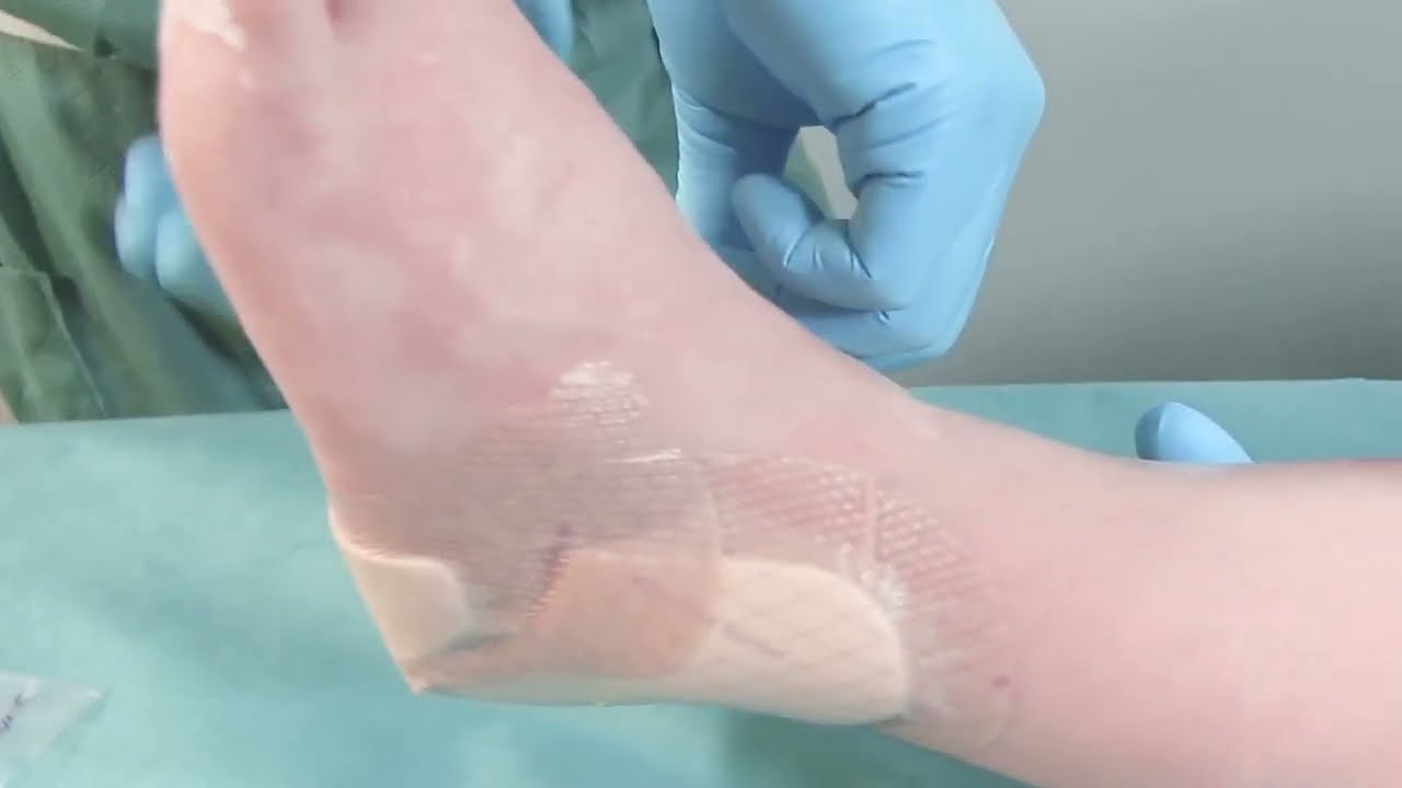 Video de aplicación Mepilex Border Heel