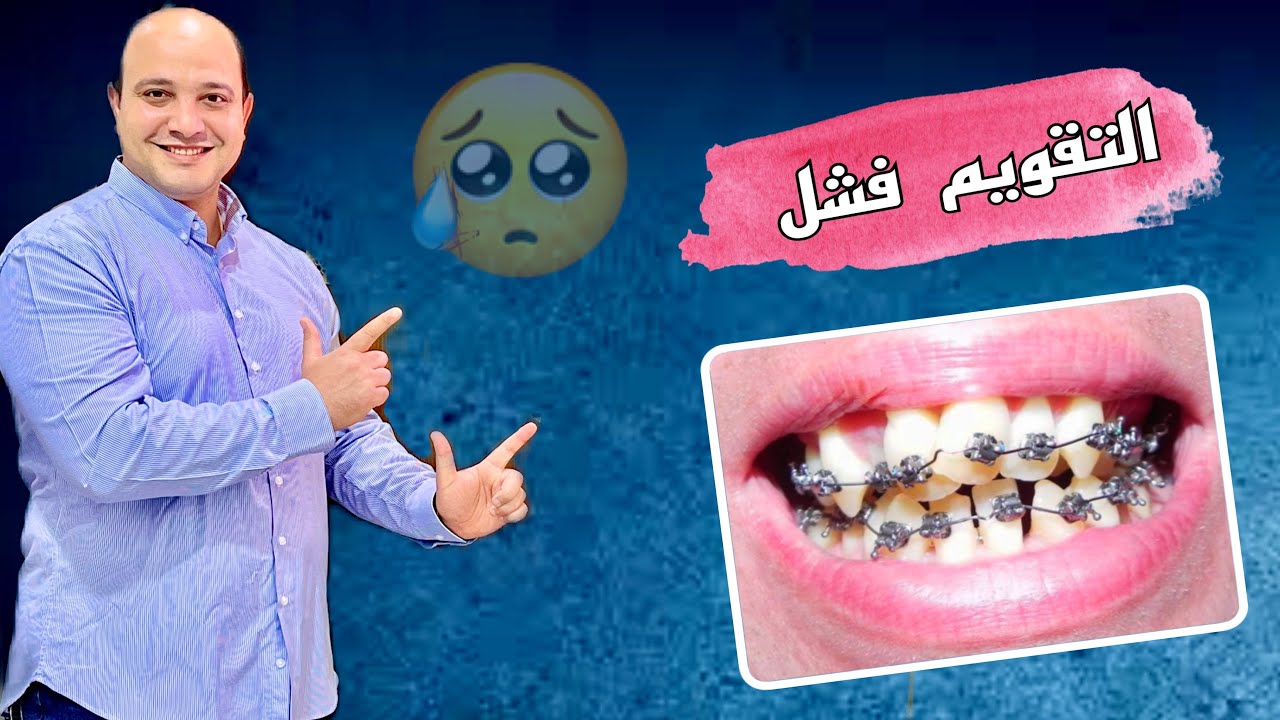 فشل تقويم الأسنان 😰  | هل ممكن إعادة التقويم ؟؟
