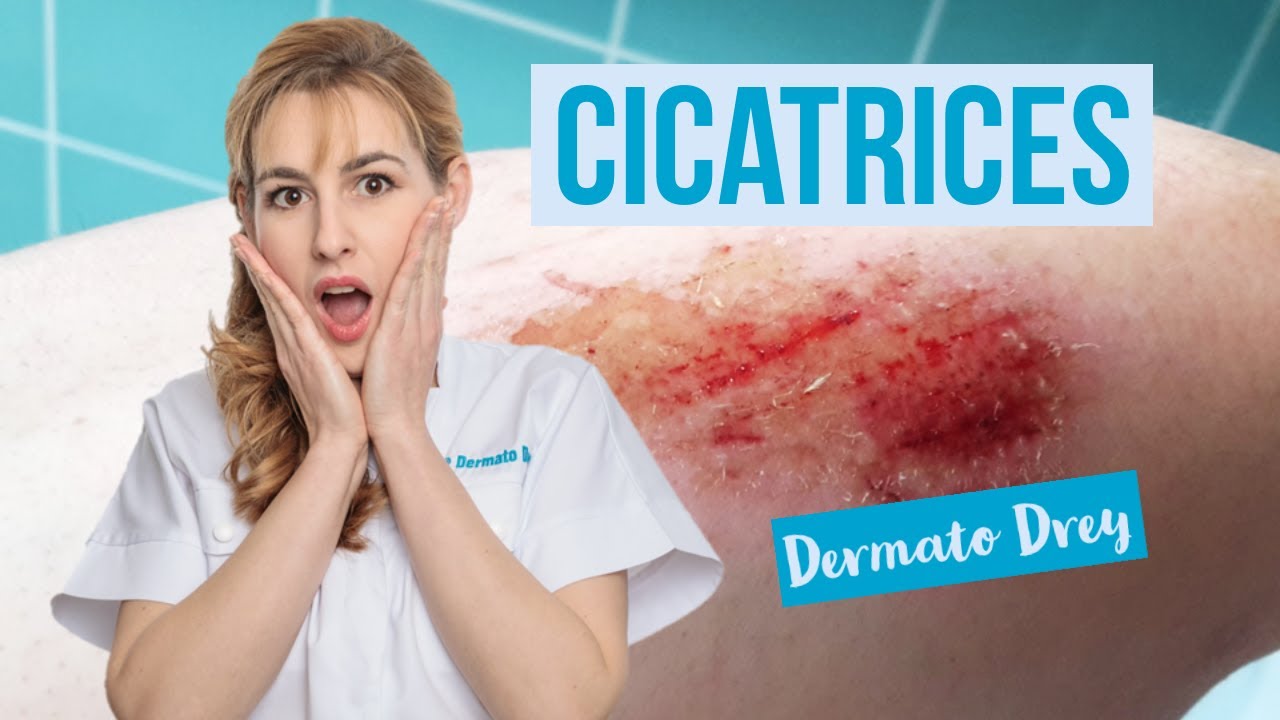 Les cicatrices ! Pourquoi elles se forment, comment les effacer ? #DermatoDrey