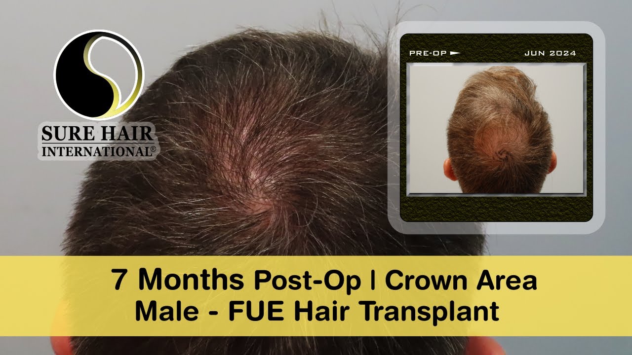 47 yr old Male - FUE Crown Area