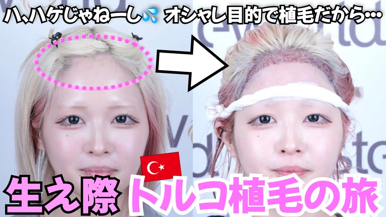 【女性 おでこ植毛】 トルコ植毛したい女性に教えたい事があります【ハウスダスト｜整形｜自毛植毛｜薄毛の窓口】