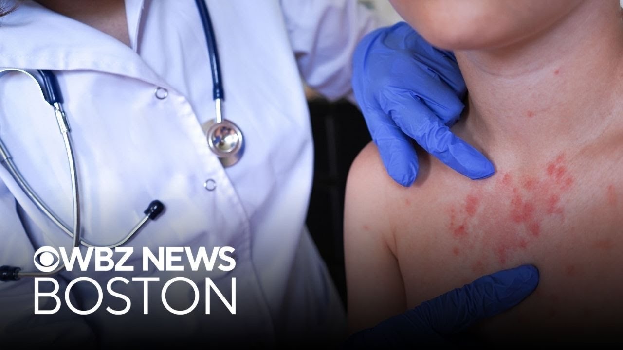 2 Massachusetts residents diagnosed with measles, infectious disease doctor explains concerns
