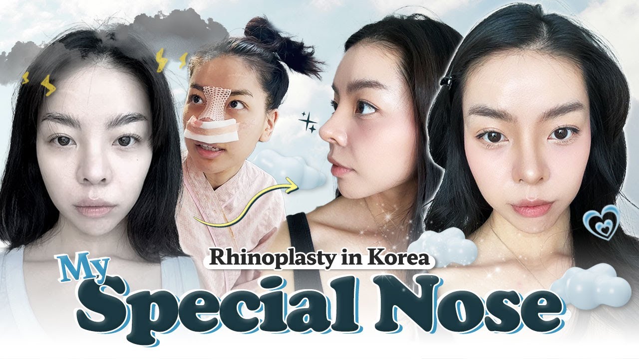 I got a new nose in Korea and I LOVE it! | Nana's rhinoplasty at Braun PART 1 💖