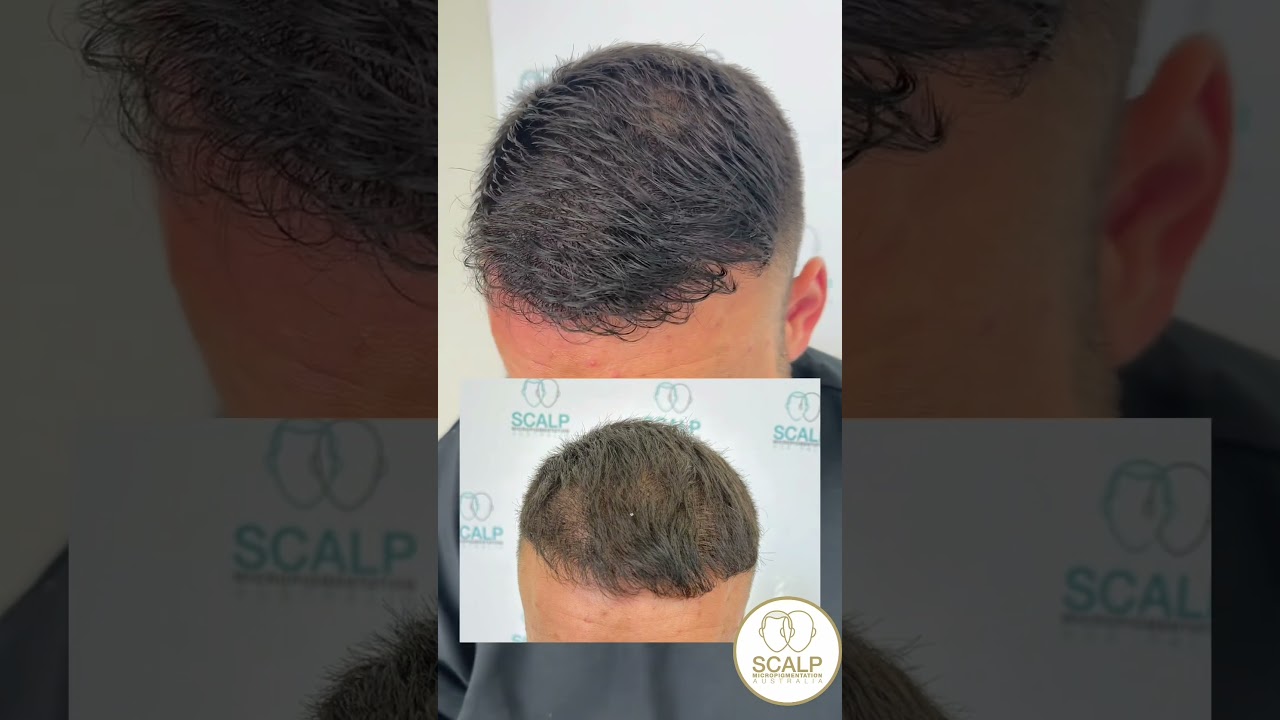 Scalp MicroPigmentation the #1 hair loss treatment density effect #hairtattoo #smp