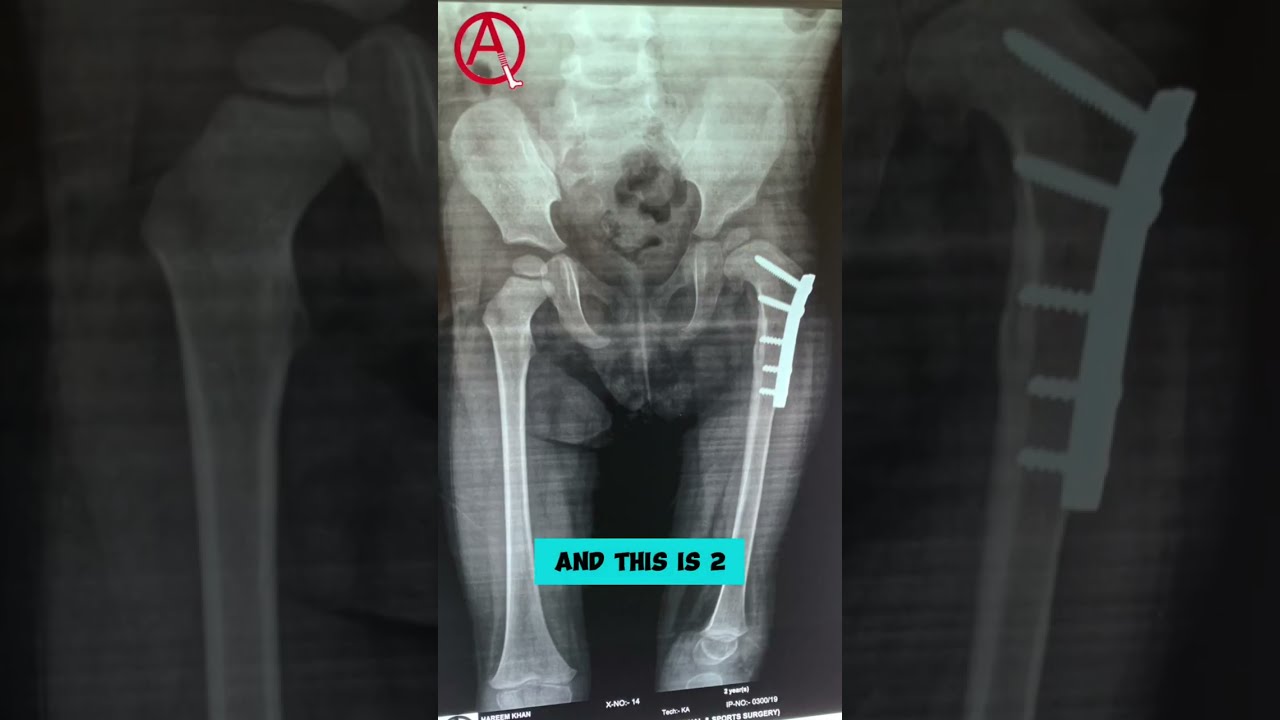 Developmental Dysplasia of the Hip (DDH)