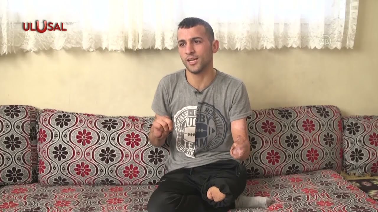 Bacağını ve kolunu kaybeden Hacı Aka protez desteğiyle yaşamak istiyor