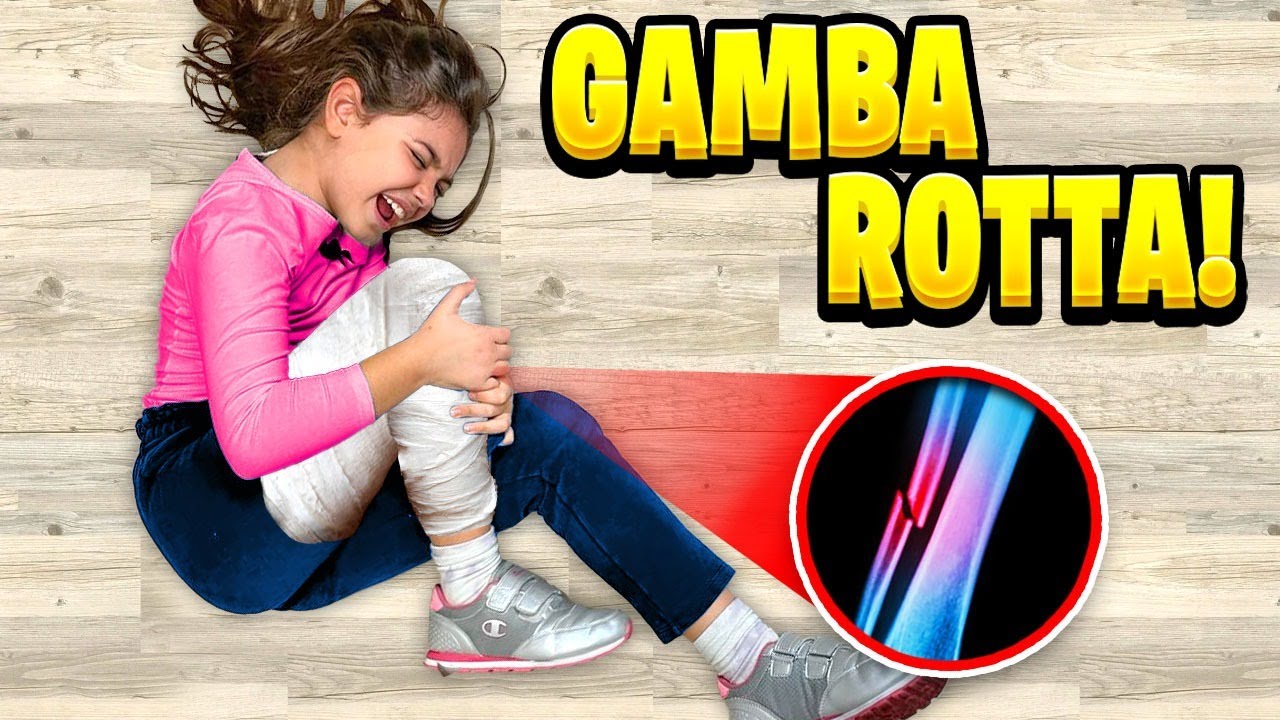 GIULIA CADE E SI FA MALE E SI ROMPE LA GAMBA MENTRE GIOCA A NASCONDINO CON MAMMA E CHICCO!