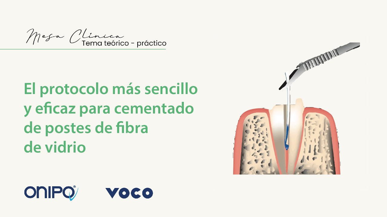 El protocolo más sencillo y eficaz para cementado de postes de fibra de vidrio