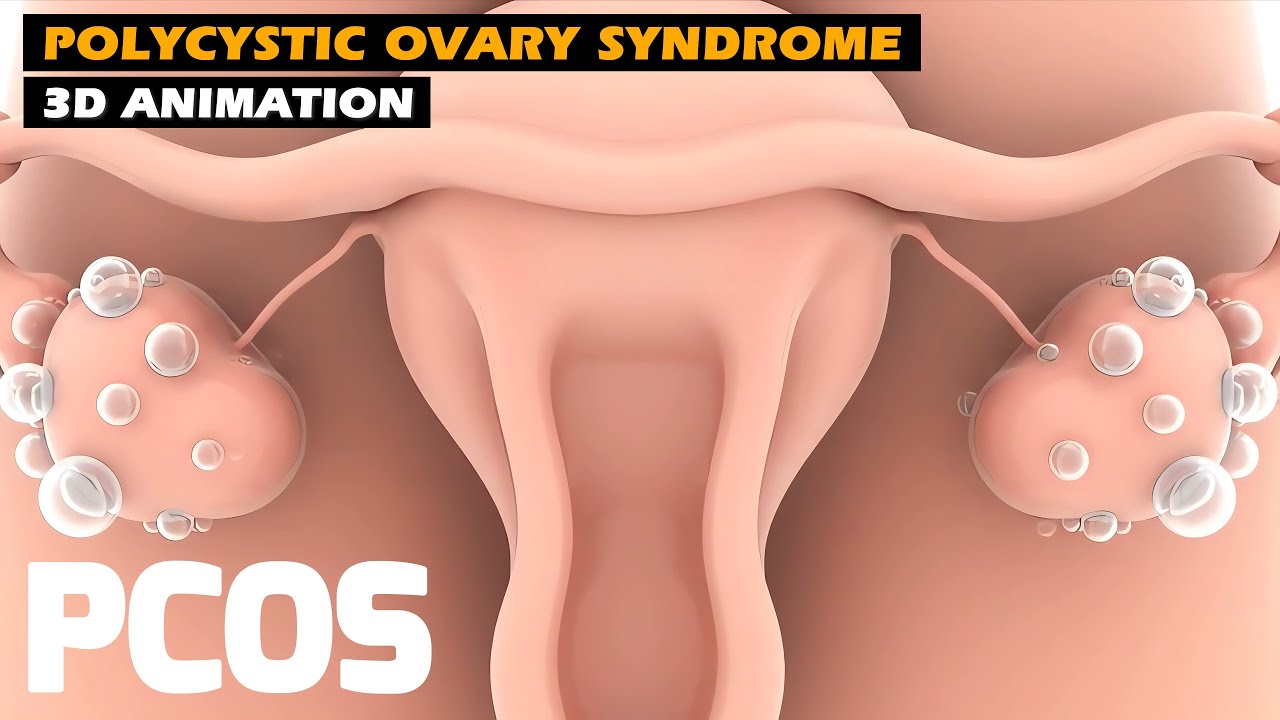 Polycystic Ovary Syndrome 