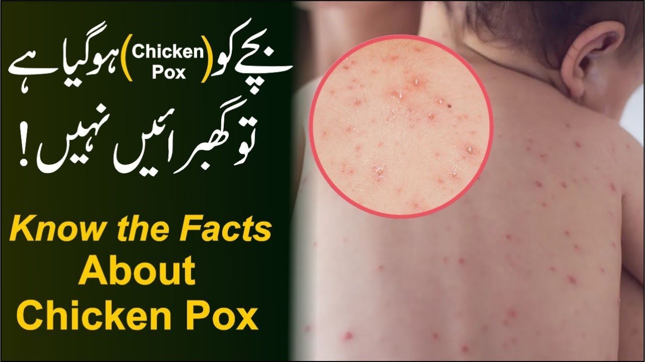Chicken Pox in children, Myths,Prevention and Treatment at Home | Urdu,Hindi