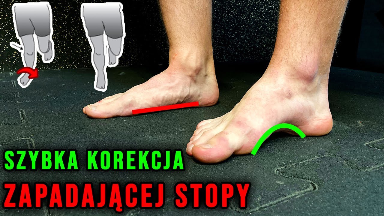 Płaskostopie w ruchu *ćwiczenie korekcyjne* ból stopy i pięty - przyczyna?
