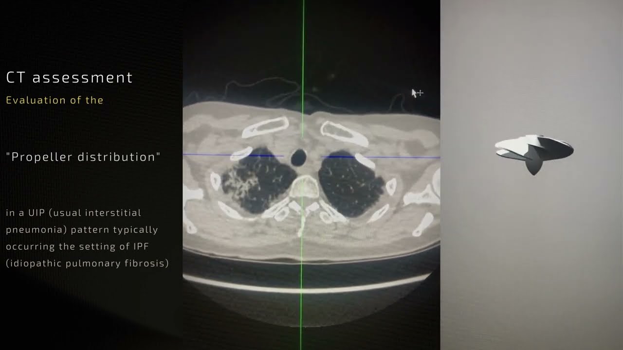 CT assessment - 