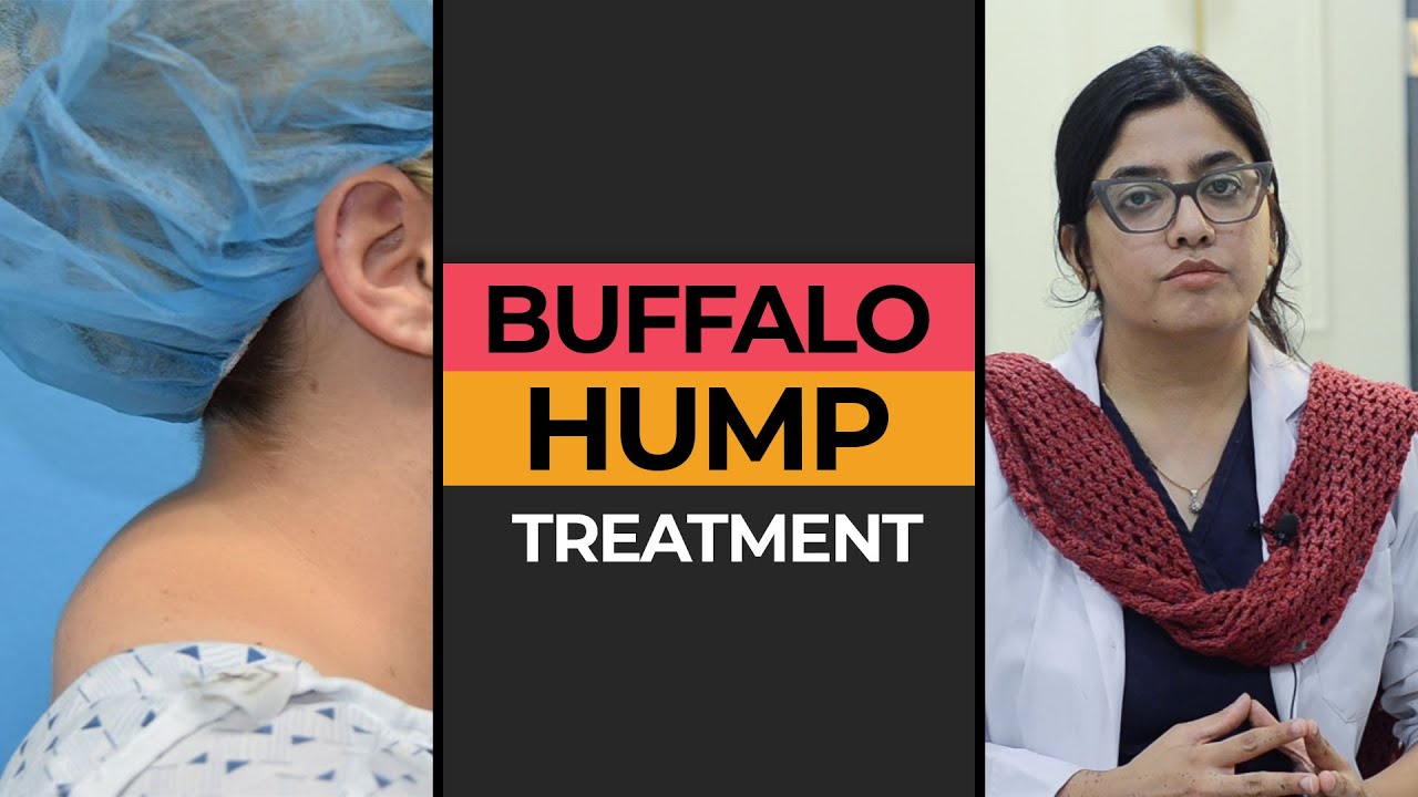 Buffalo Hump Treatment in Karachi | Neck Hump | Plastic Surgery