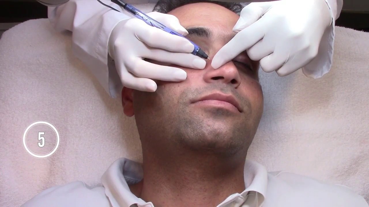 La thermocoagulation avec le système Vascu Lyse 2G RF