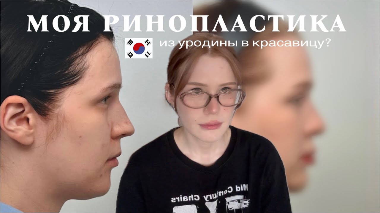 моя ринопластика в корее
