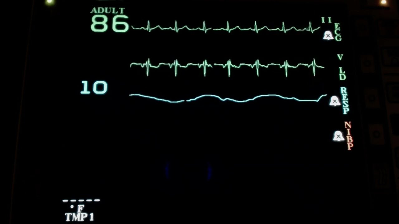 Resting Heart with the Prism monitor