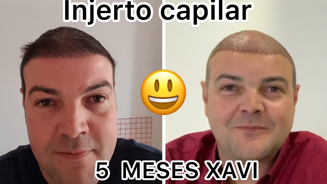 Trasplante capilar o injerto capilar Xavi 5 meses