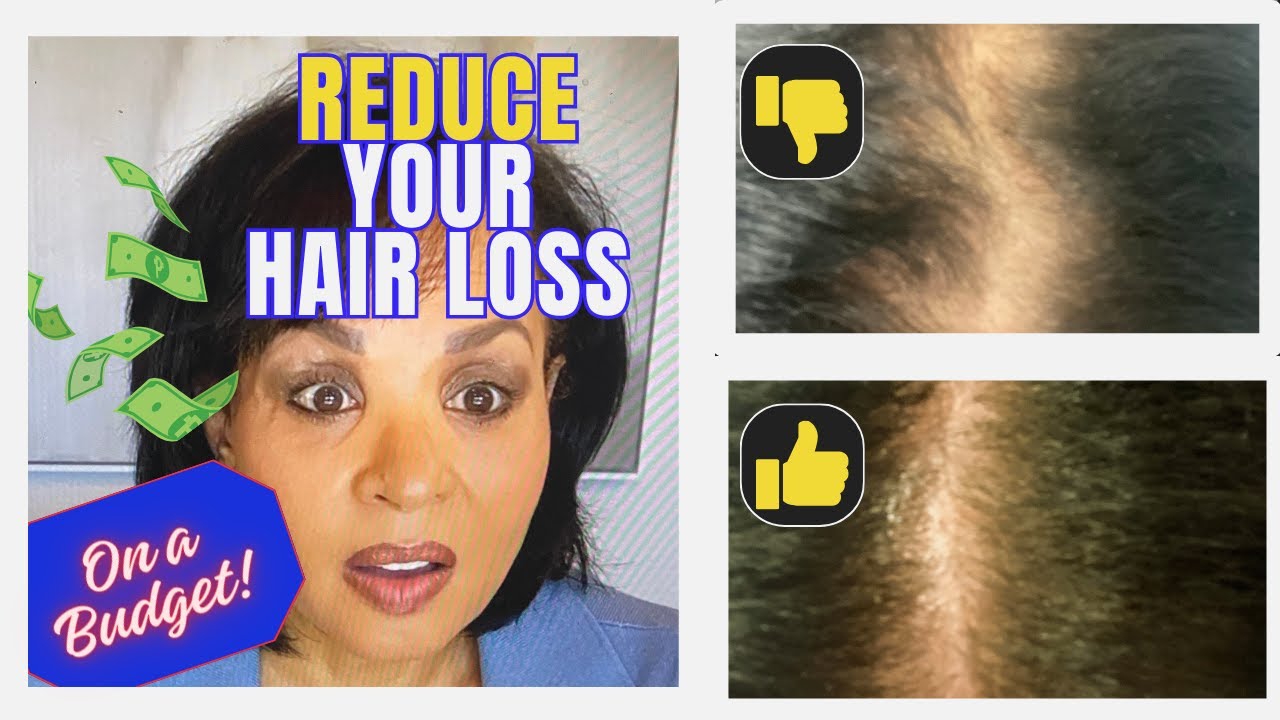 Get Your Hair Back: Low Cost...Budget Hair Restoration Plan
