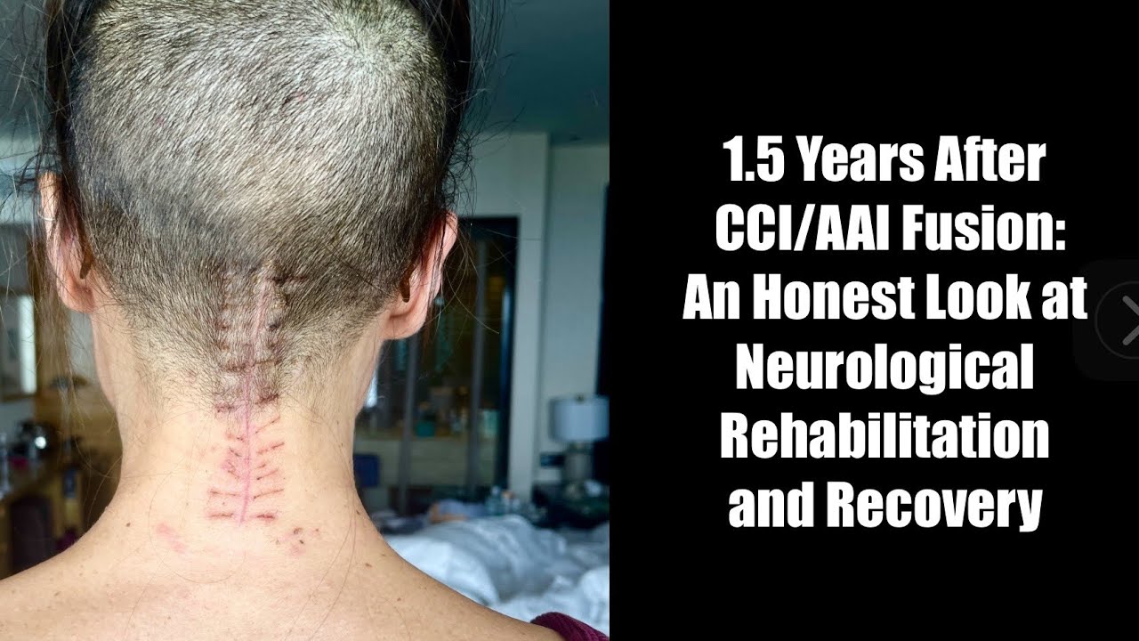 1.5 Years After CCI/AAI Fusion: An Honest Look at Neurological Rehabilitation: Recovery #CCI #MECFS