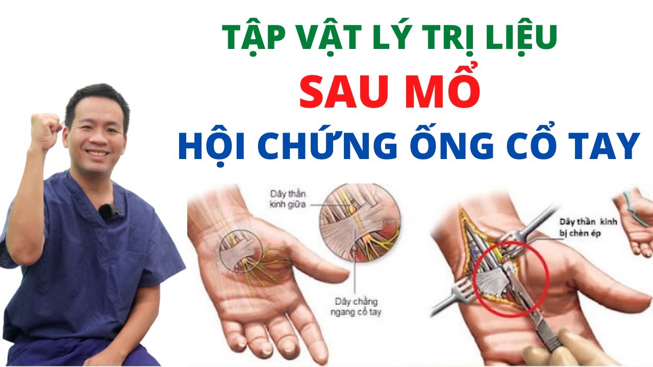 Hướng dẫn tập vật lý trị liệu SAU MỔ hội chứng ống cổ tay | Khớp Việt Official
