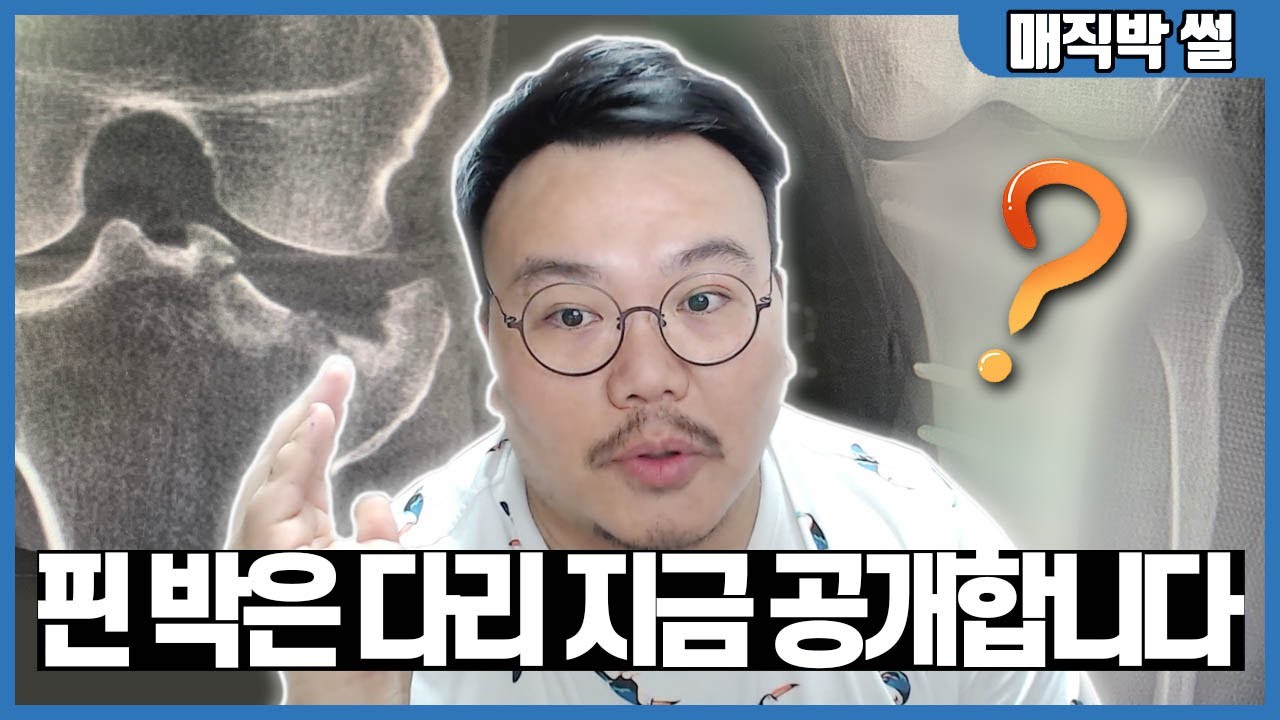 분쇄 골절 된 제 다리, 수술 전/후 사진 비교 들어갑니다.