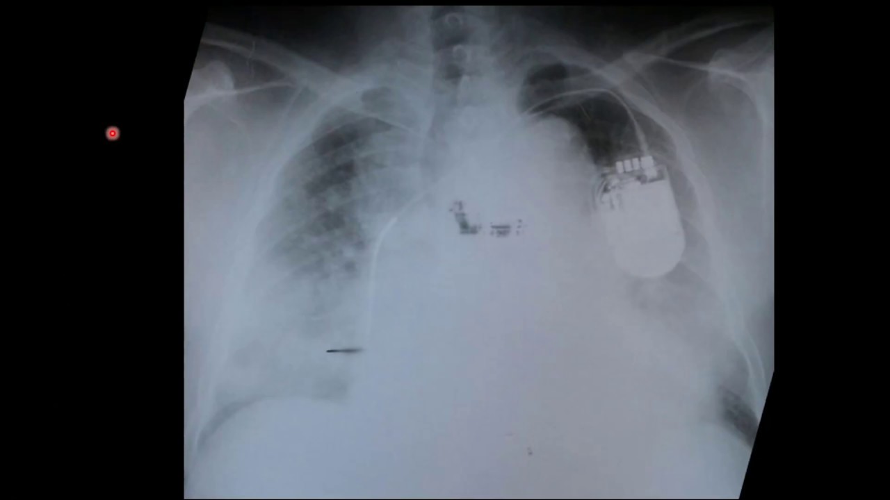 COMO AVALIAR O RX DE UM PACIENTE CARDIOPATA?