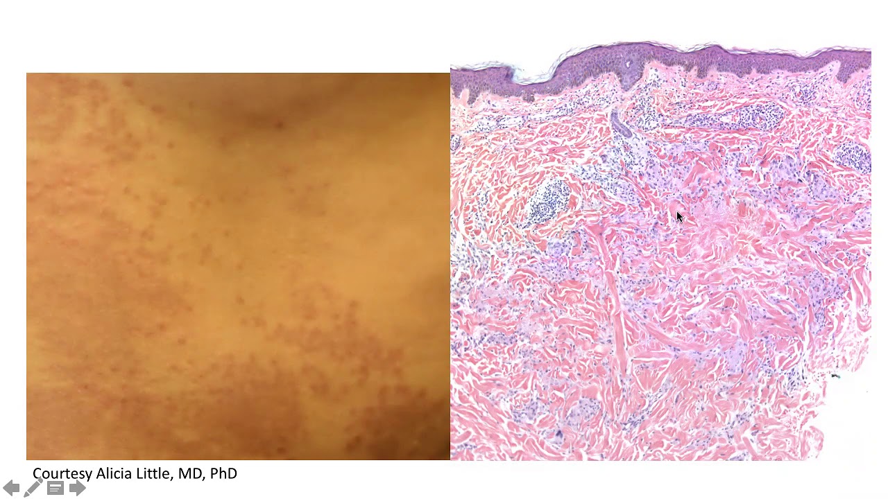 DP60 episode 202 pink brown papules
