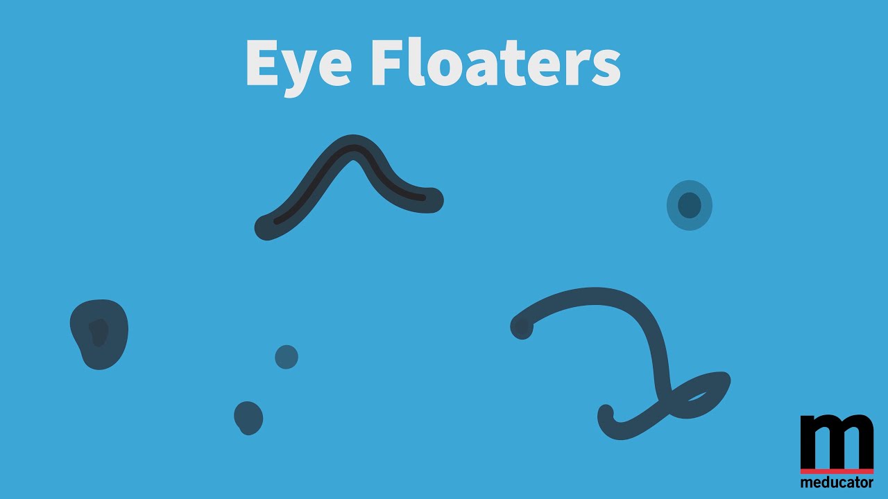 Eye Floaters