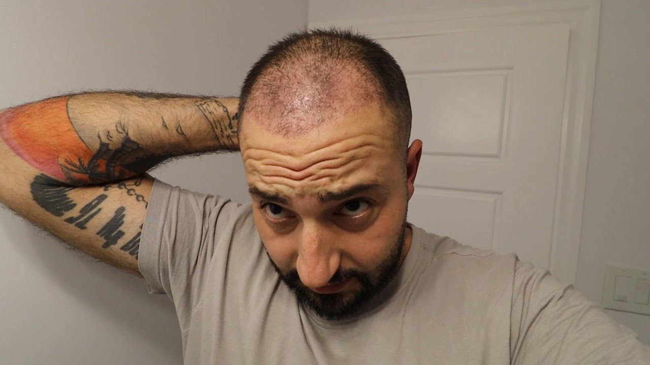 40 DAYS AFTER MY HAIR TRANSPLANT SURGERY TURKEY & ITS NOT LOOKING GOOD!