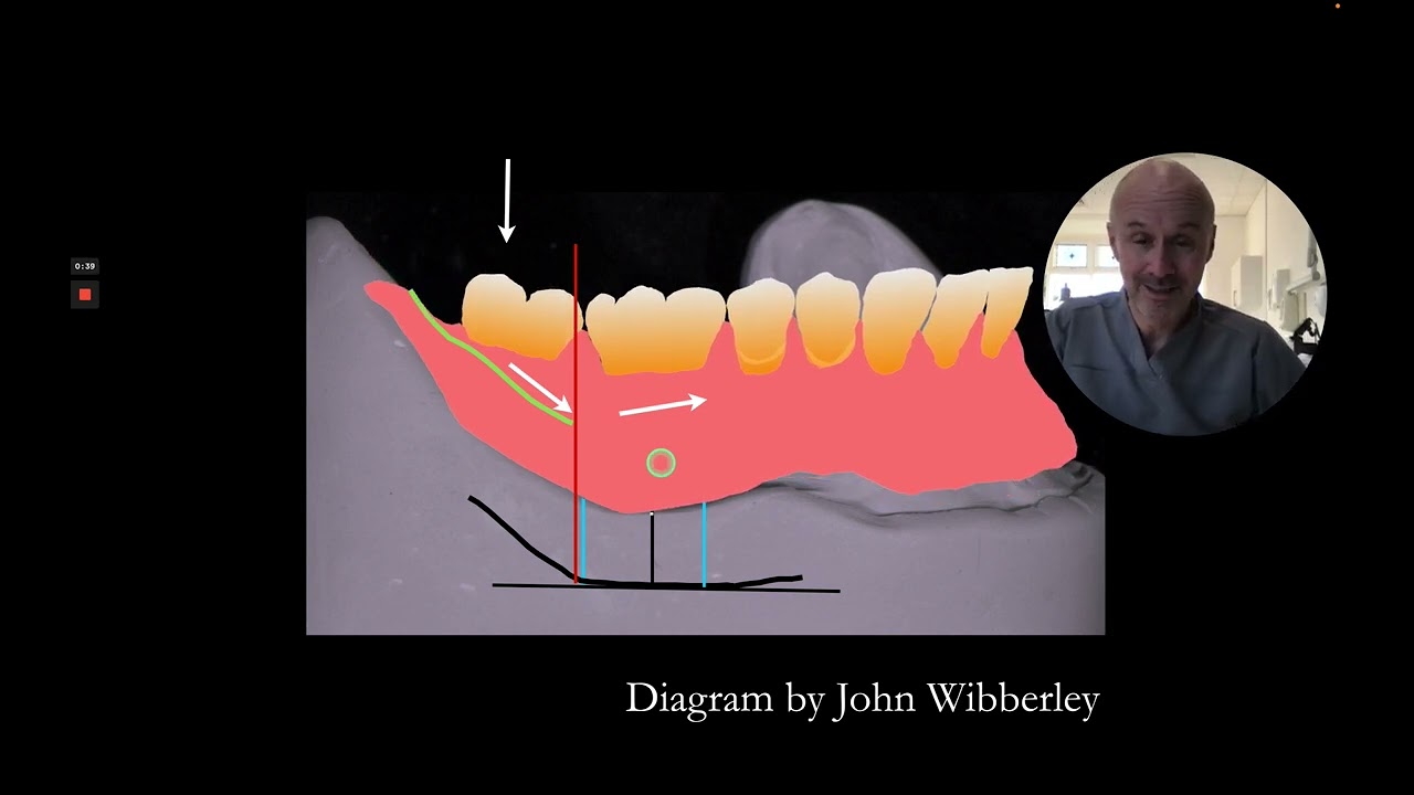 Leave off the second molars for complete dentures