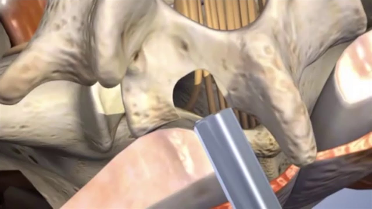 Laminotomy Animation - 360 Ortho and Spine