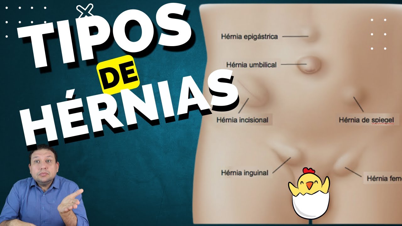 TIPOS DE H&Eacute;RNIA que podem ocorrer na nossa barriga !!