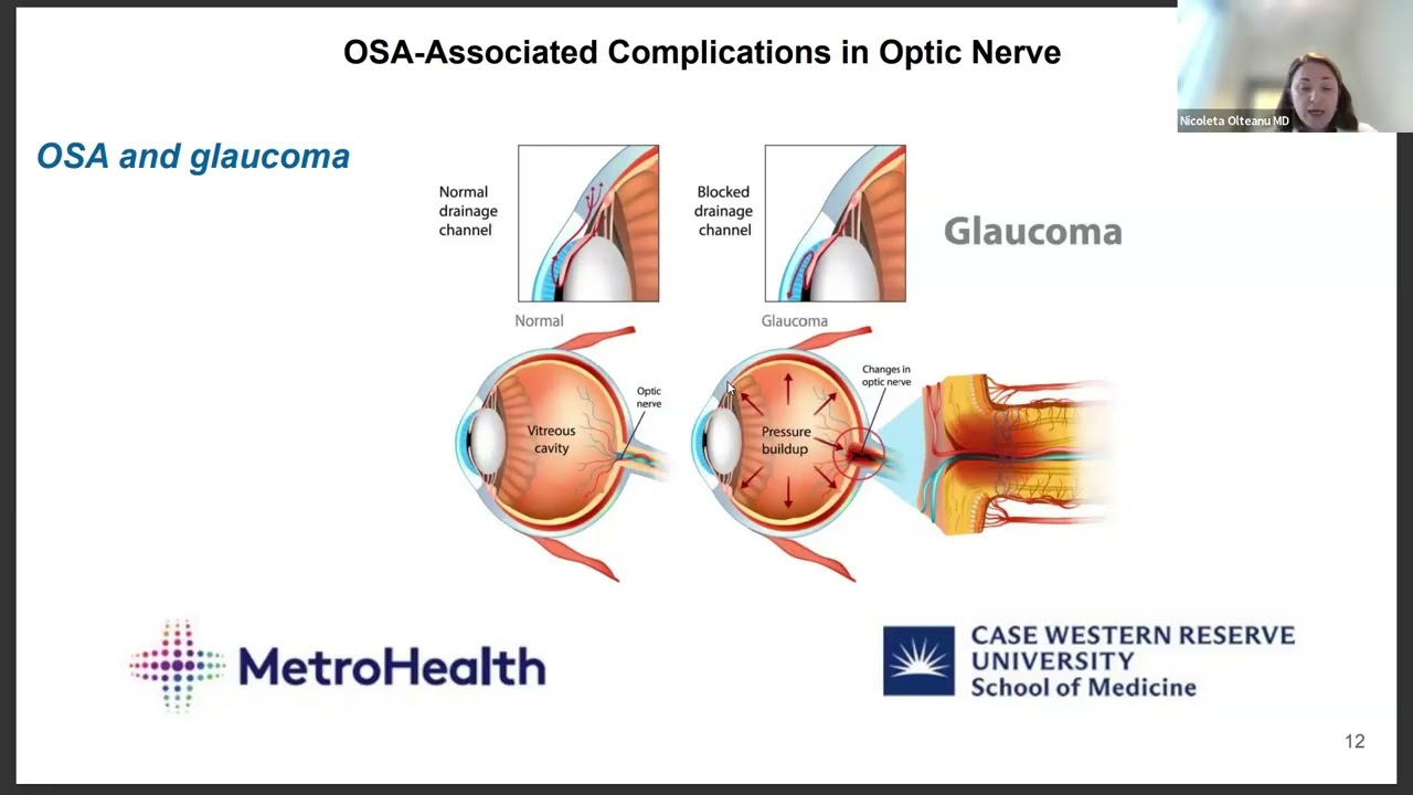 2025.04.08 - CWRU SMGR: Dr. Nicoleta Olteanu - Obstructive Sleep Apnea and Eye Disorders