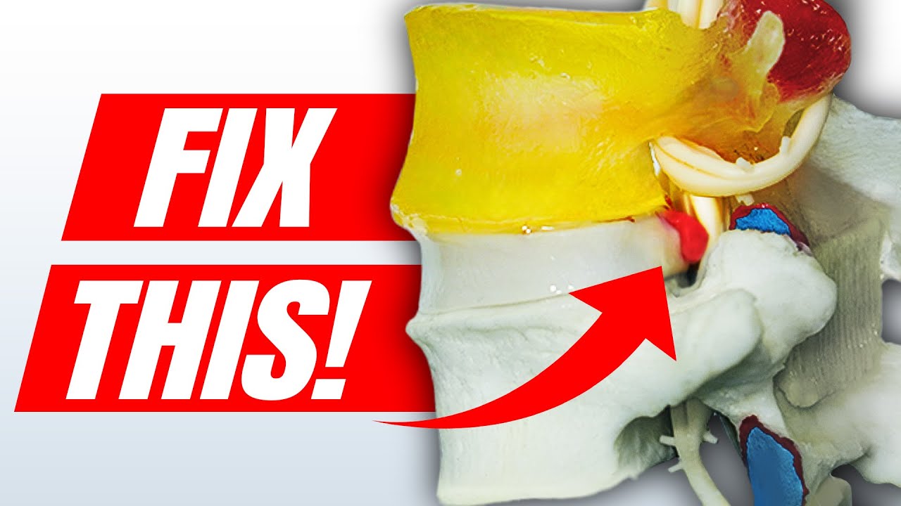 How to Fix a Bulging Disc in Your Lower Back