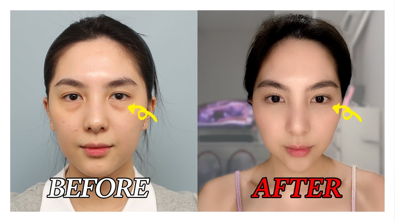 Real Experience: From Booking to the Day Before Under-eye Fat Repositioning Surgery!🩷
