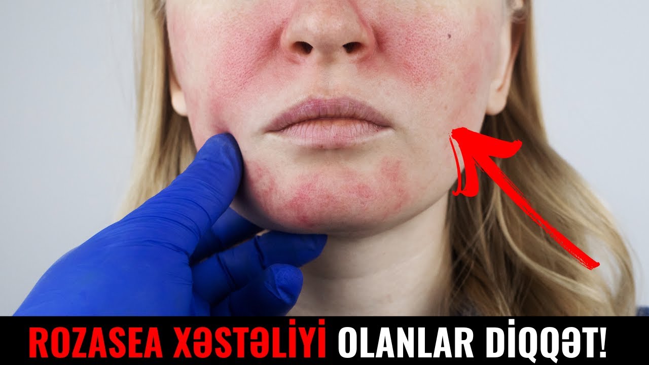 &Uuml;z&uuml;n&uuml;zdə bu c&uuml;r qızartı varsa DİQQƏT! - ROZASEA