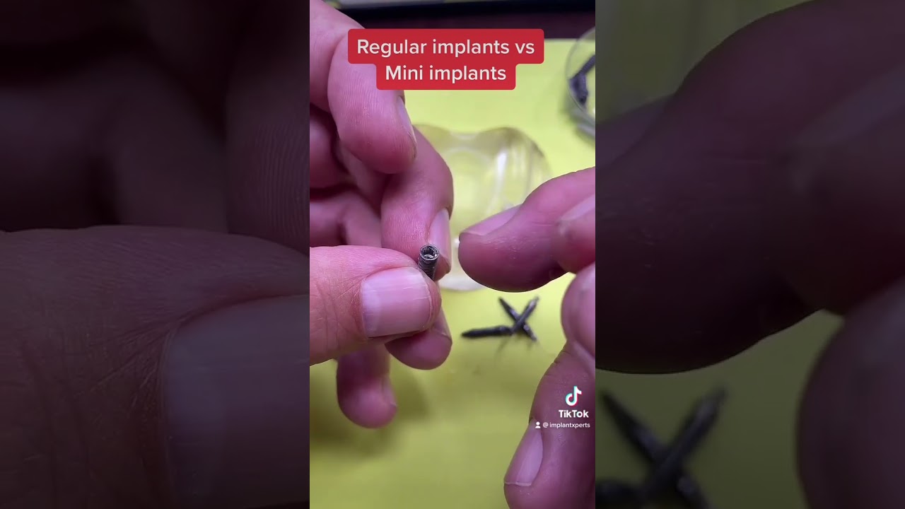 Regular implants vs Mini Implants
