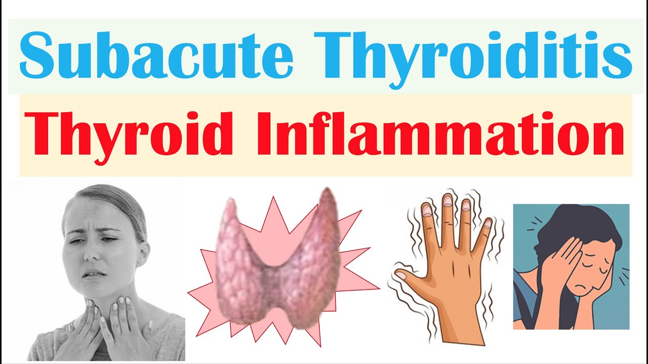Subacute Thyroiditis (Thyroid Inflammation; De Quervain&rsquo;s) | Causes, Symptoms, Diagnosis, Treatment