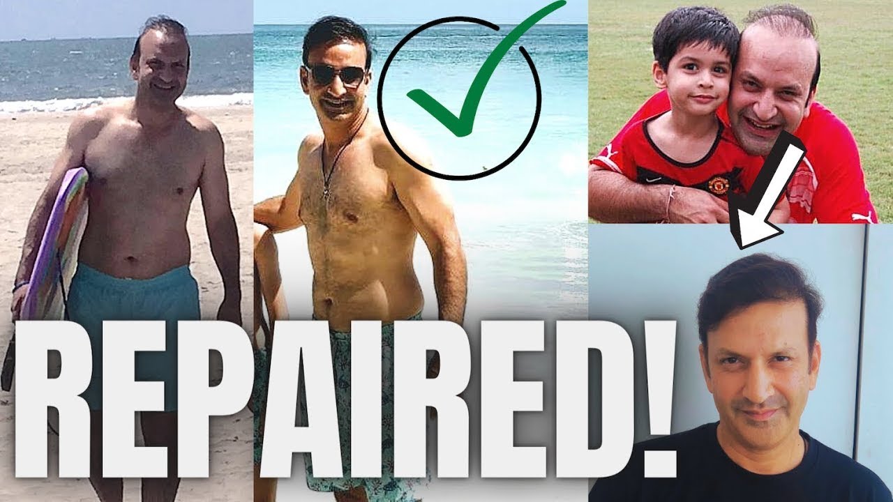 Best Hair Transplant Repair  11,500 Grafts Norwood 7 Hair Redemption