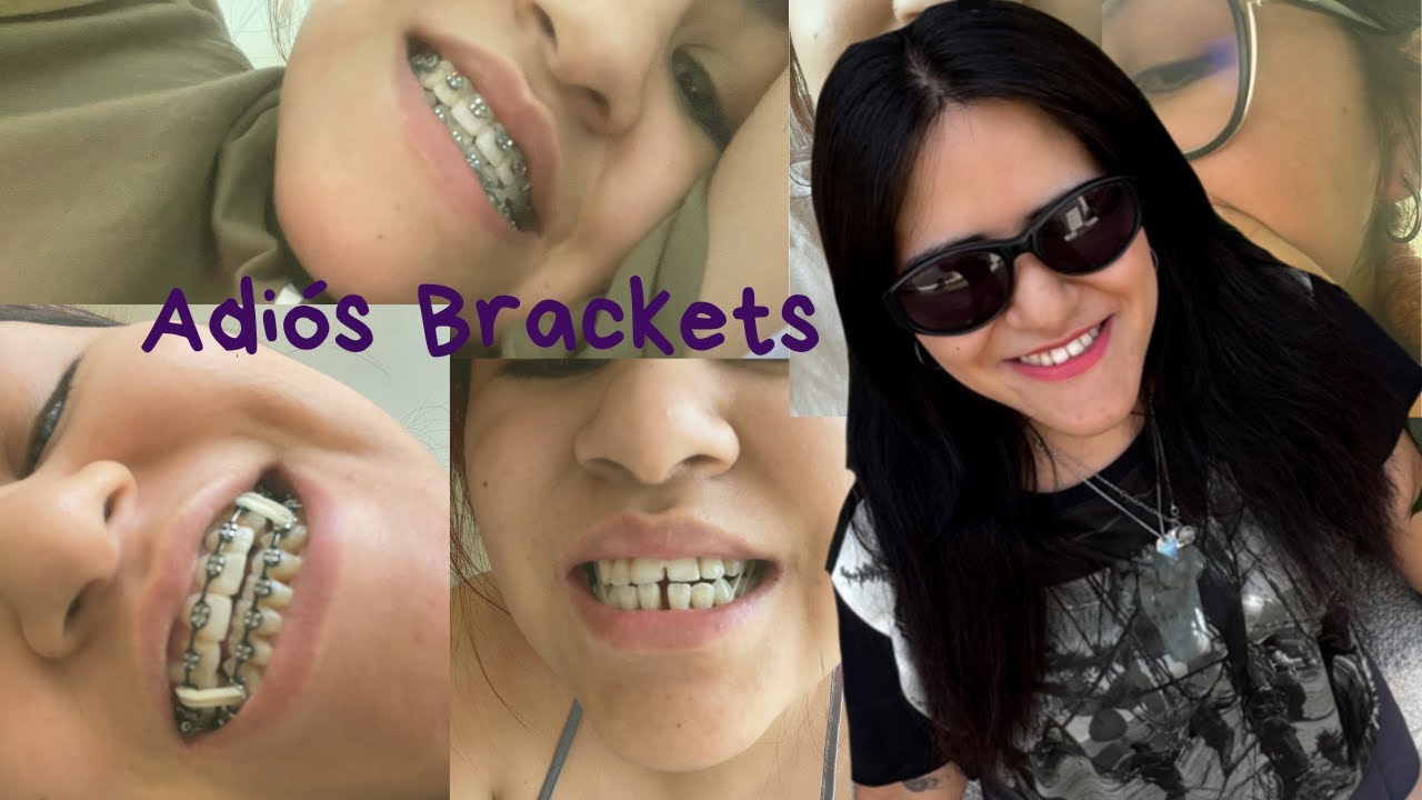 Me sacaron los brackets 😄