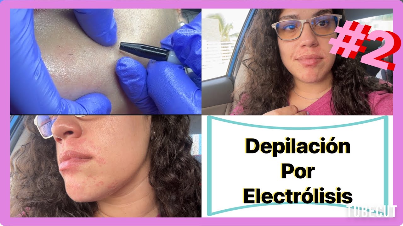 Depilación Por Electrólisis | Regreso Sesión # 2