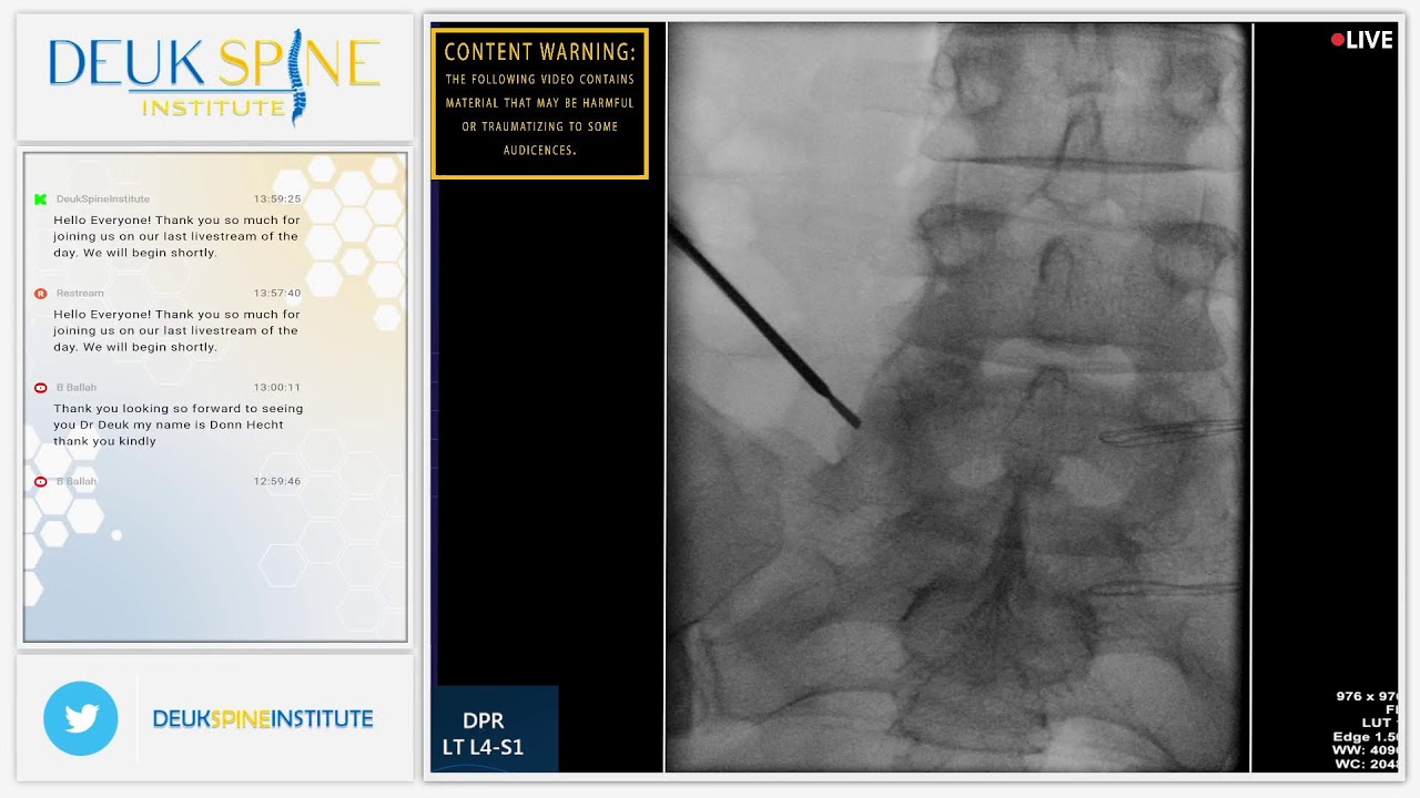 Lumbar Deuk Plasma Rhizotomy L4-S1 for Lower Back Pain from Facet Joint Arthropathy