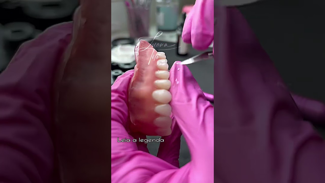 Acriliza&ccedil;&atilde;o de pr&oacute;tese total&hellip;  Evitando o ressecamento . #shorts #protesetotal #protetico #dentist